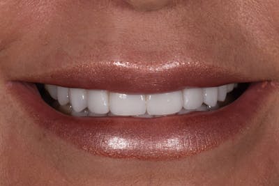 Patient Smile Before & After Gallery - Patient 150554 - Image 2