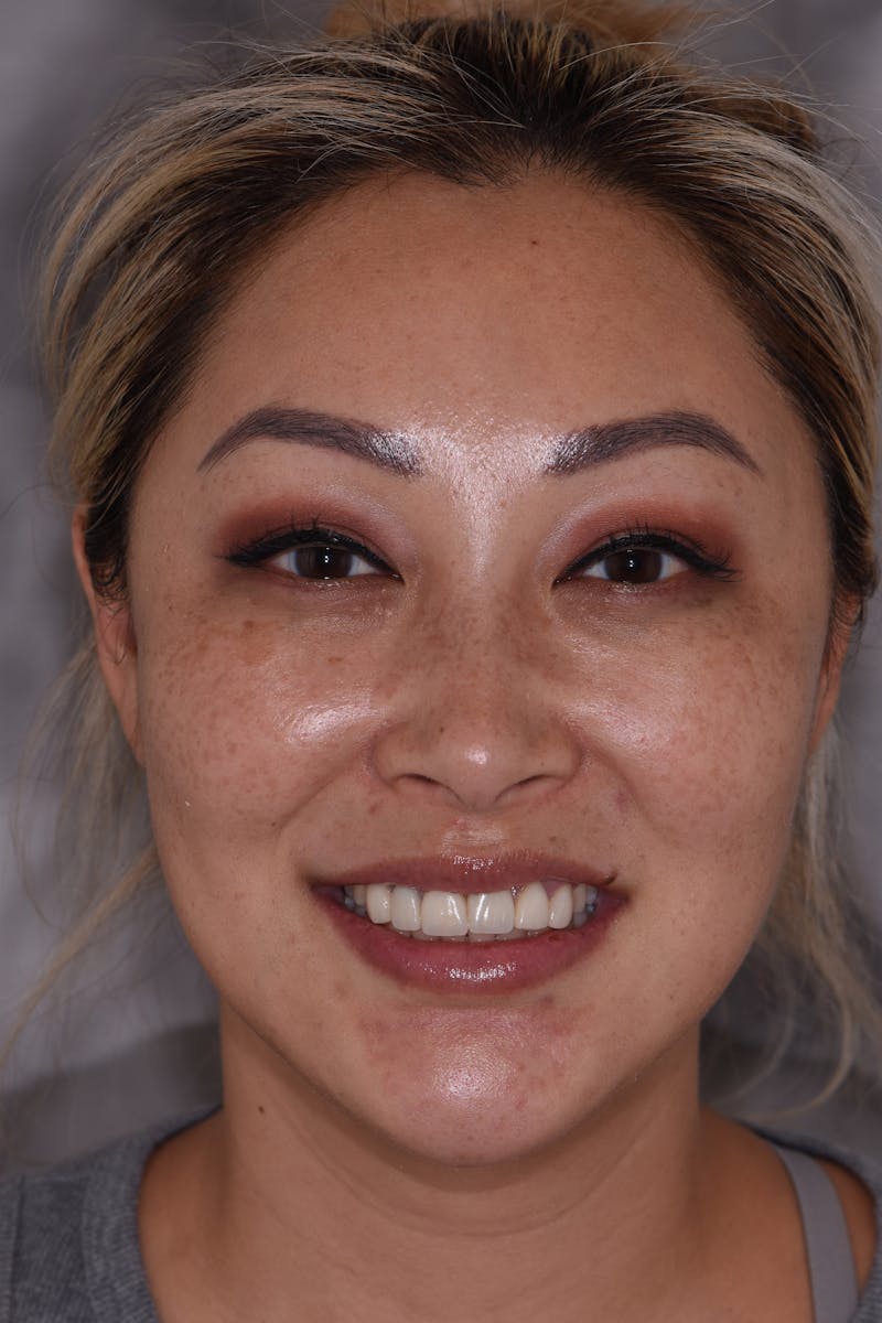 Patient Smile Before & After Gallery - Patient 370677 - Image 1