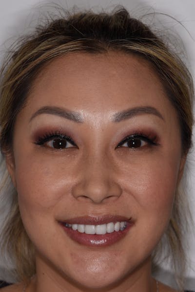 Patient Smile Before & After Gallery - Patient 370677 - Image 2