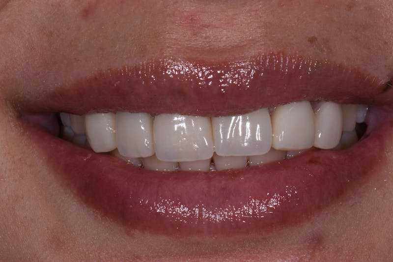 Patient Smile Before & After Gallery - Patient 370677 - Image 3
