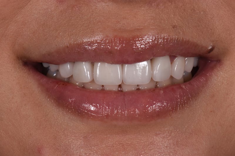 Patient Smile Before & After Gallery - Patient 370677 - Image 4