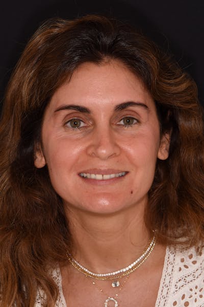 Patient Smile Before & After Gallery - Patient 392968 - Image 1