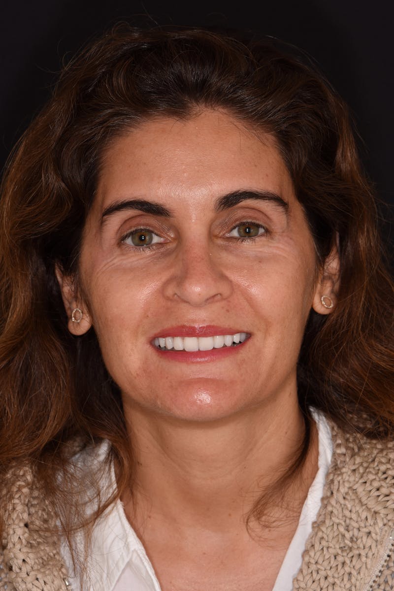 Patient Smile Before & After Gallery - Patient 392968 - Image 2