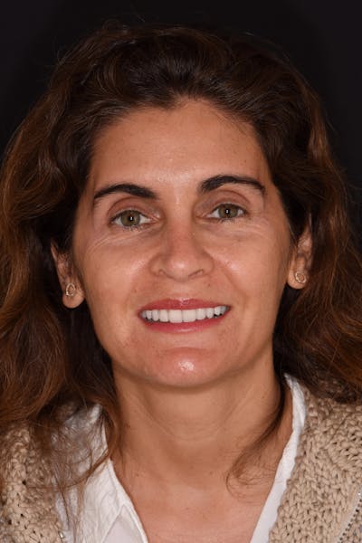 Patient Smile Before & After Gallery - Patient 392968 - Image 2