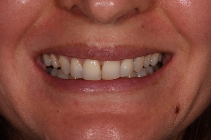 Patient Smile Before & After Gallery - Patient 392968 - Image 3