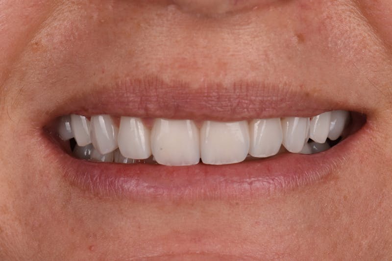 Patient Smile Before & After Gallery - Patient 392968 - Image 4