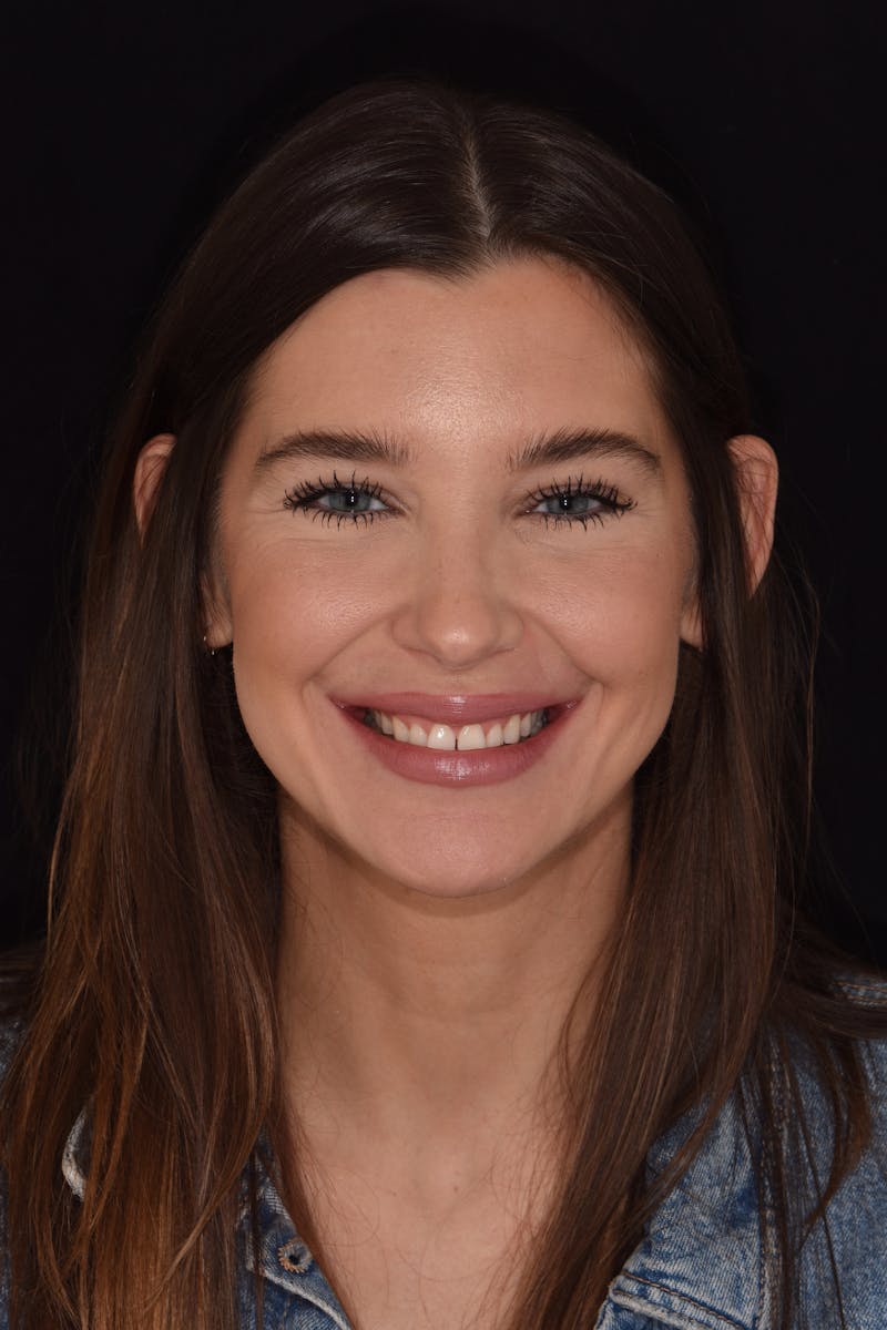 Patient Smile Before & After Gallery - Patient 367192 - Image 1