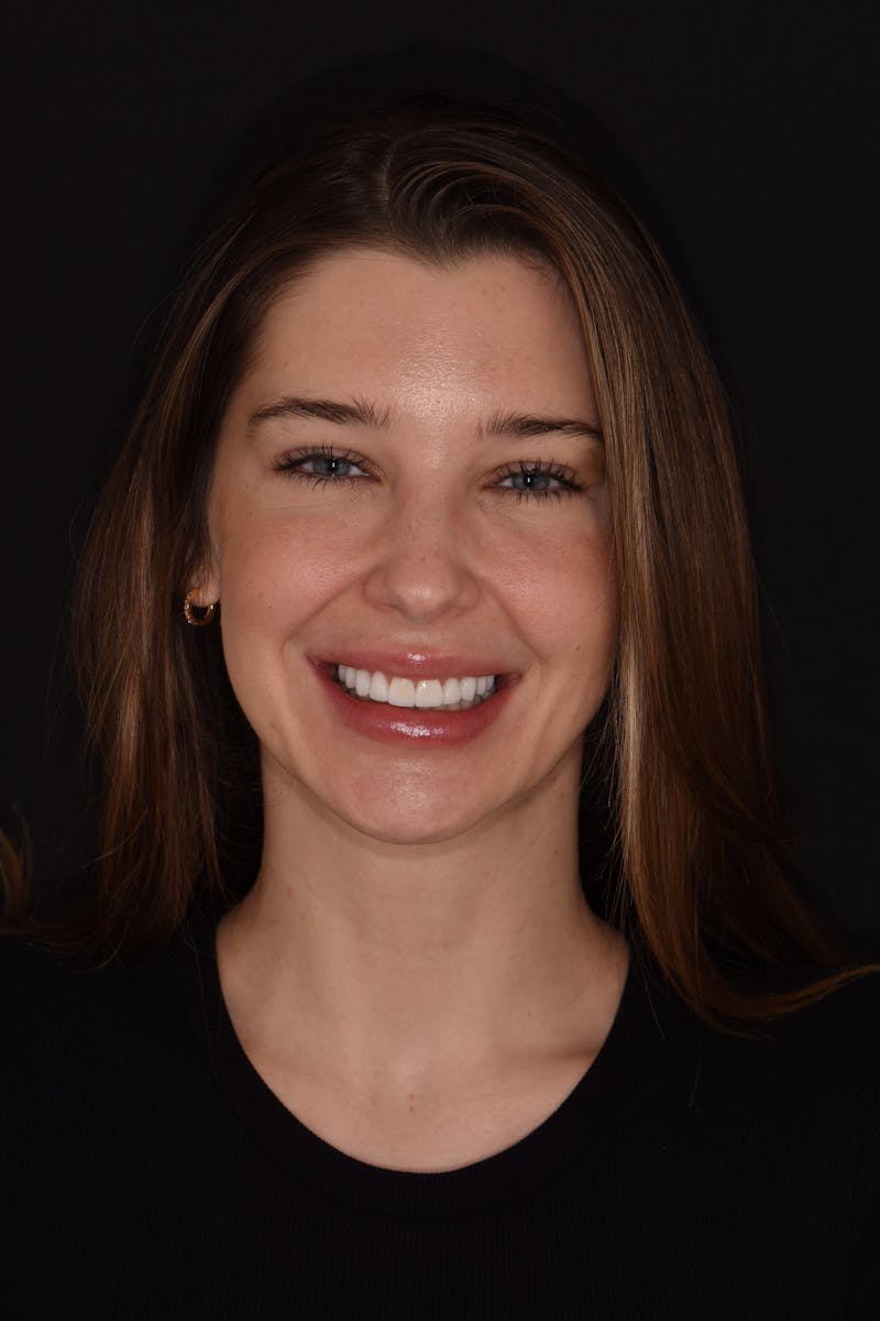 Patient Smile Before & After Gallery - Patient 367192 - Image 2