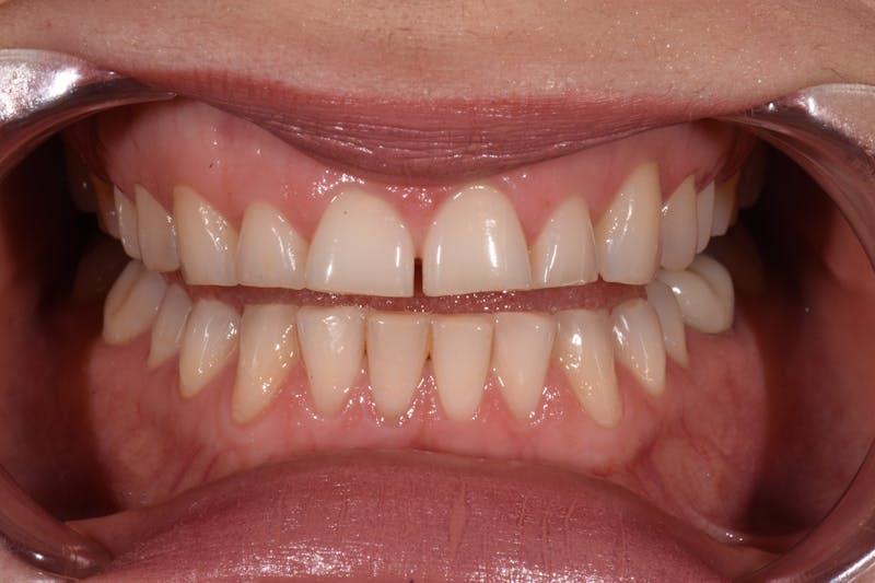 Patient Smile Before & After Gallery - Patient 367192 - Image 3