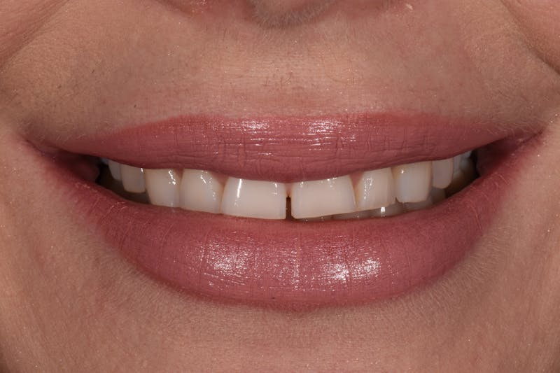 Patient Smile Before & After Gallery - Patient 367192 - Image 5