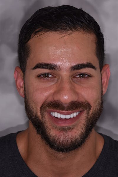 Patient Smile Before & After Gallery - Patient 367185 - Image 2