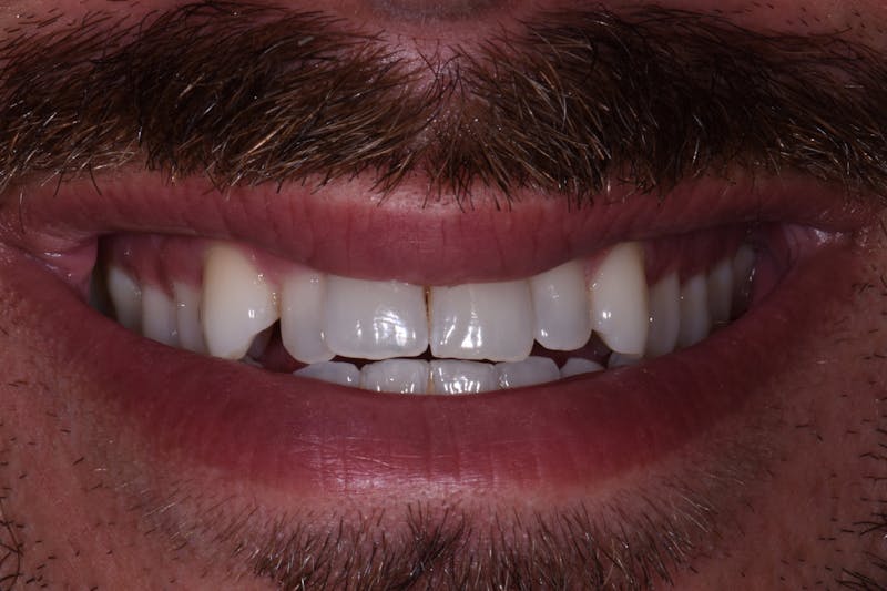 Patient Smile Before & After Gallery - Patient 367185 - Image 3