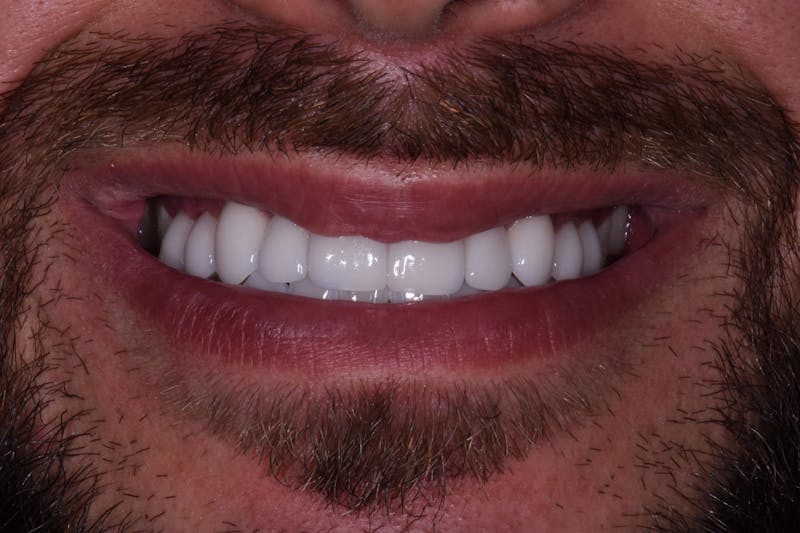 Patient Smile Before & After Gallery - Patient 367185 - Image 4