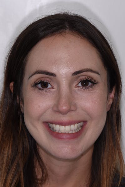 Patient Smile Before & After Gallery - Patient 518467 - Image 1