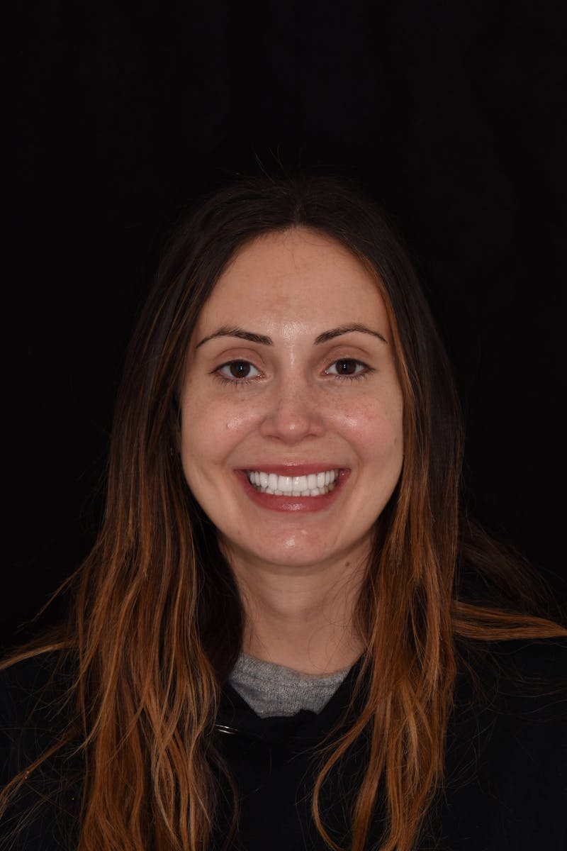 Patient Smile Before & After Gallery - Patient 518467 - Image 2