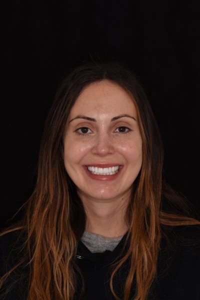 Patient Smile Before & After Gallery - Patient 518467 - Image 2