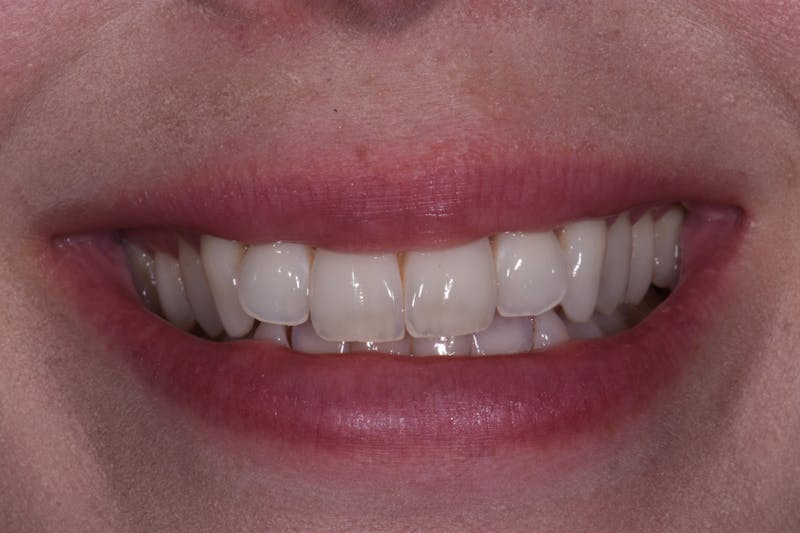Patient Smile Before & After Gallery - Patient 518467 - Image 3