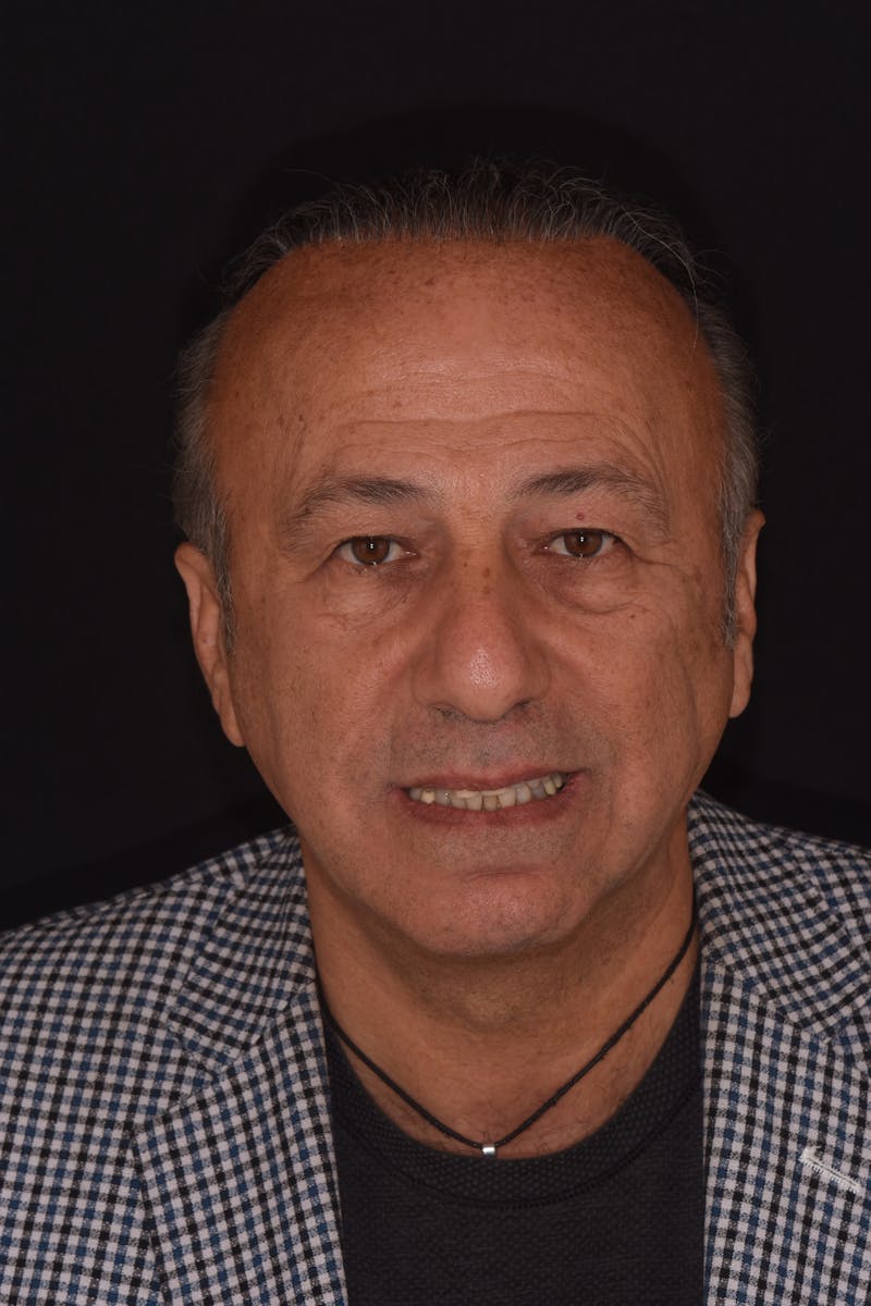 Patient Smile Before & After Gallery - Patient 346969 - Image 1