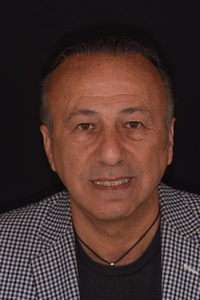 Patient Smile Before & After Gallery - Patient 346969 - Image 1