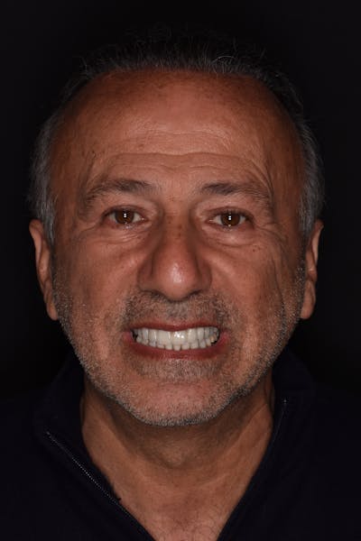 Patient Smile Before & After Gallery - Patient 346969 - Image 2