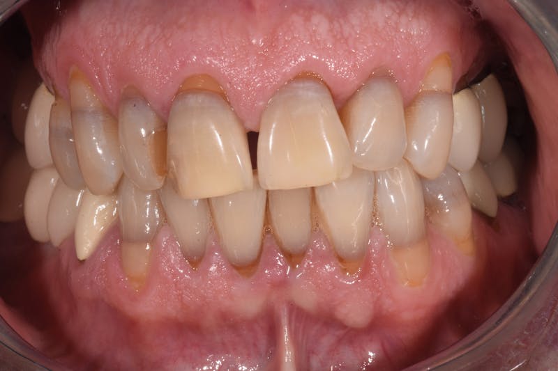 Patient Smile Before & After Gallery - Patient 346969 - Image 3