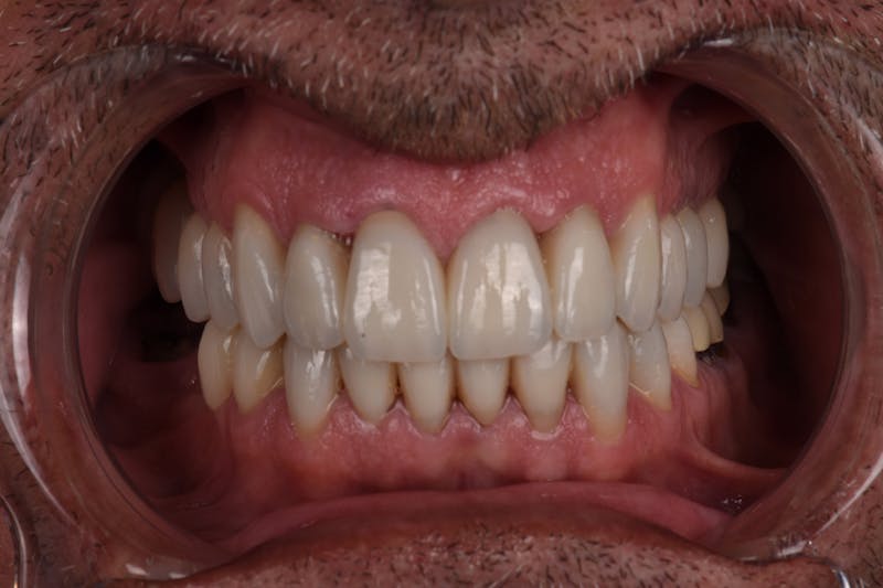 Patient Smile Before & After Gallery - Patient 346969 - Image 4