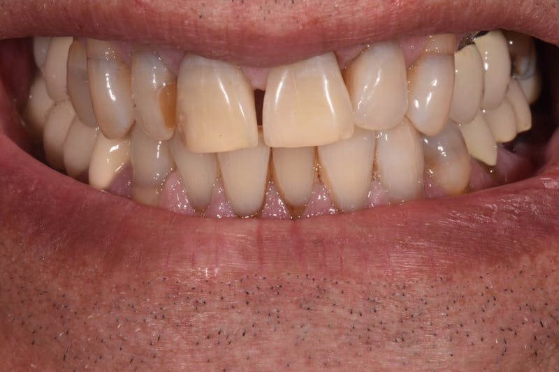 Patient Smile Before & After Gallery - Patient 346969 - Image 5