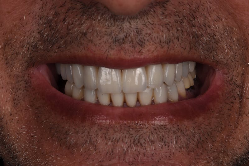 Patient Smile Before & After Gallery - Patient 346969 - Image 6
