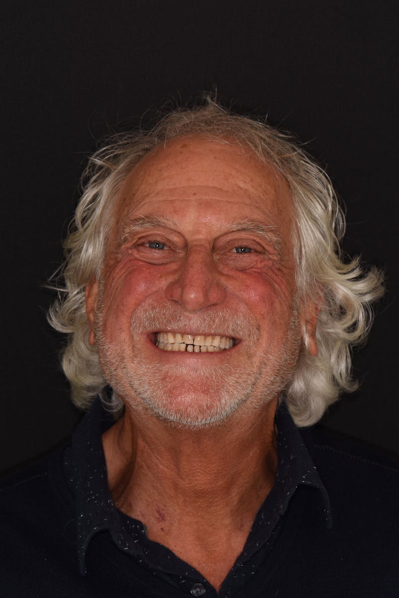 Patient Smile Before & After Gallery - Patient 301598 - Image 1