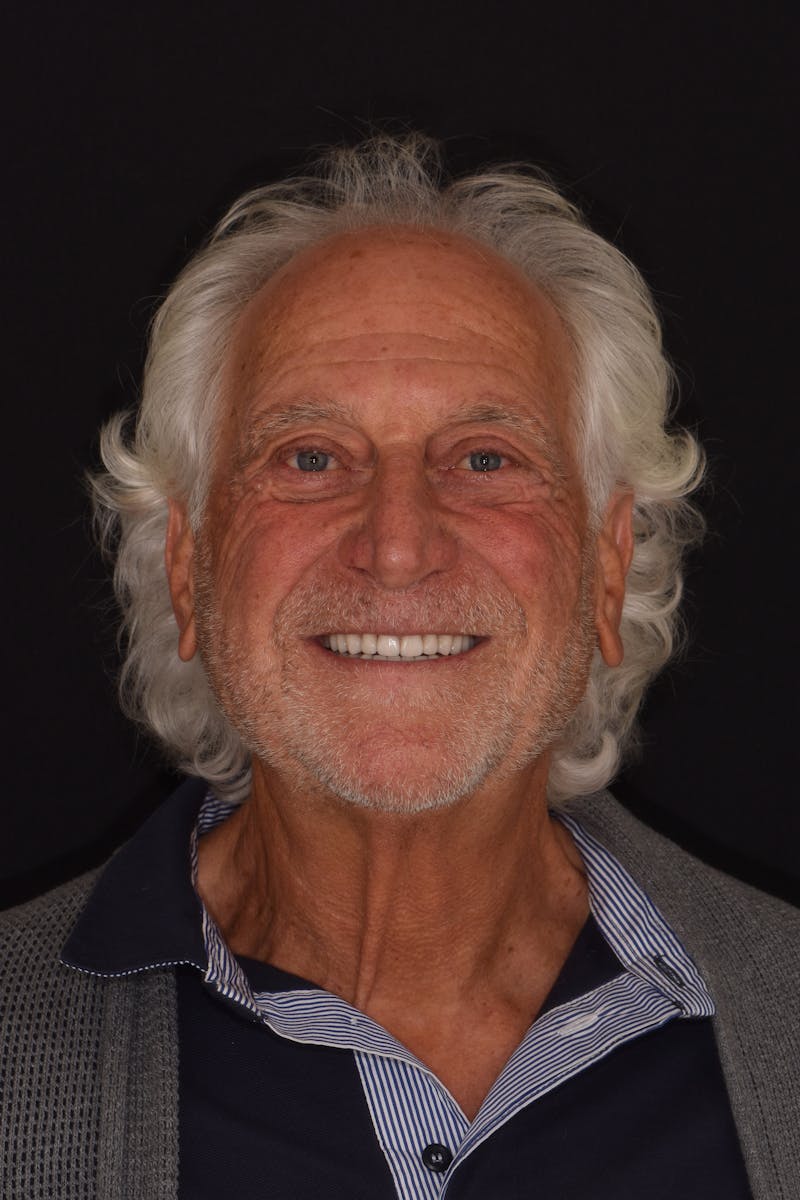 Patient Smile Before & After Gallery - Patient 301598 - Image 2