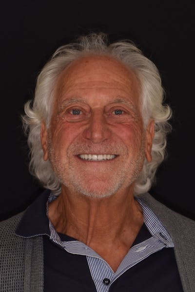 Patient Smile Before & After Gallery - Patient 301598 - Image 2