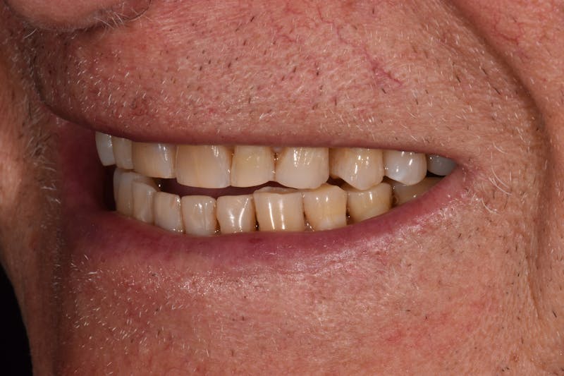 Patient Smile Before & After Gallery - Patient 301598 - Image 3