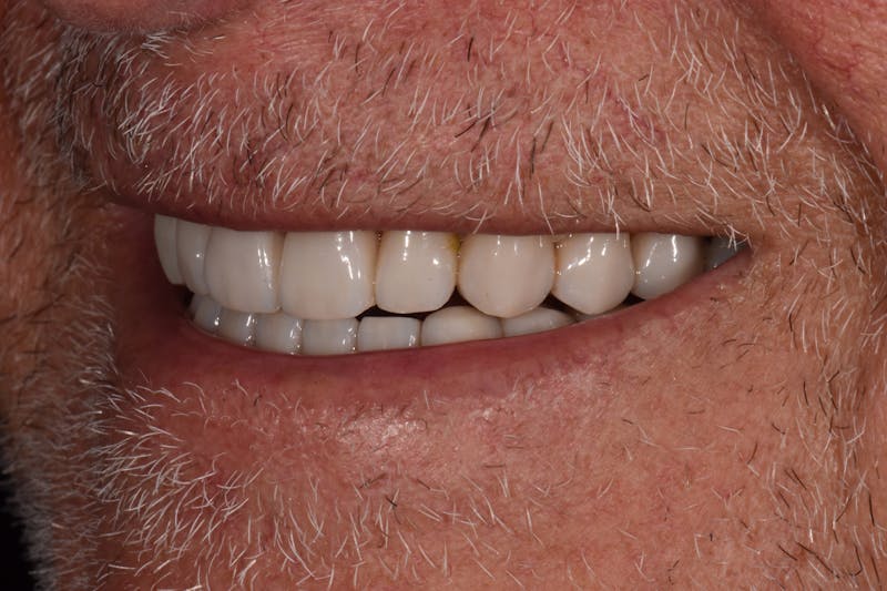 Patient Smile Before & After Gallery - Patient 301598 - Image 4
