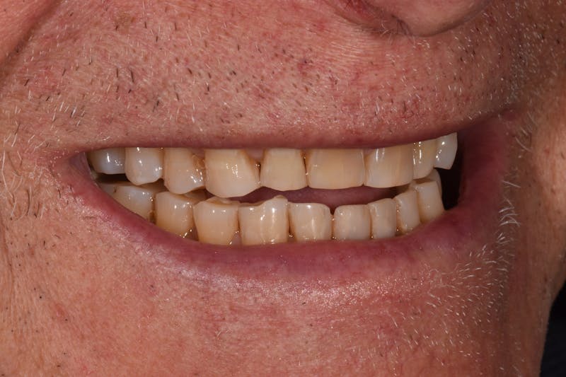 Patient Smile Before & After Gallery - Patient 301598 - Image 5