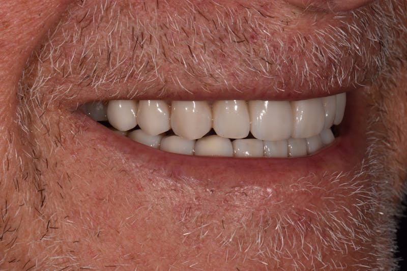 Patient Smile Before & After Gallery - Patient 301598 - Image 6