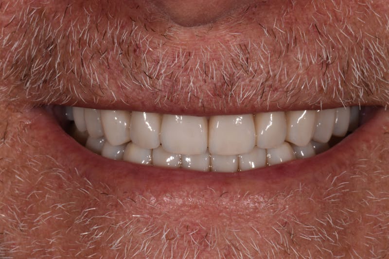 Patient Smile Before & After Gallery - Patient 301598 - Image 8