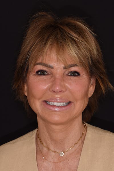 Patient Smile Before & After Gallery - Patient 866798 - Image 2