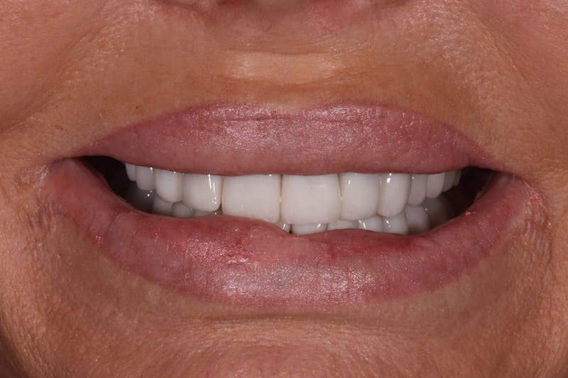 Patient Smile Before & After Gallery - Patient 866798 - Image 3