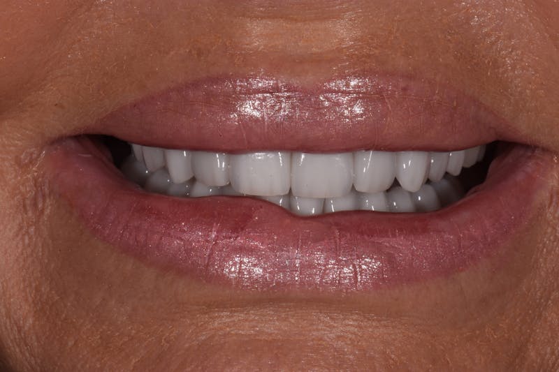 Patient Smile Before & After Gallery - Patient 866798 - Image 4