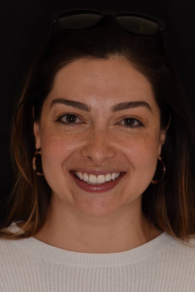 Patient Smile Before & After Gallery - Patient 352467 - Image 2