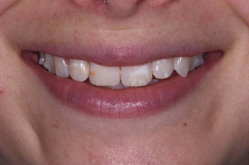 Patient Smile Before & After Gallery - Patient 352467 - Image 3