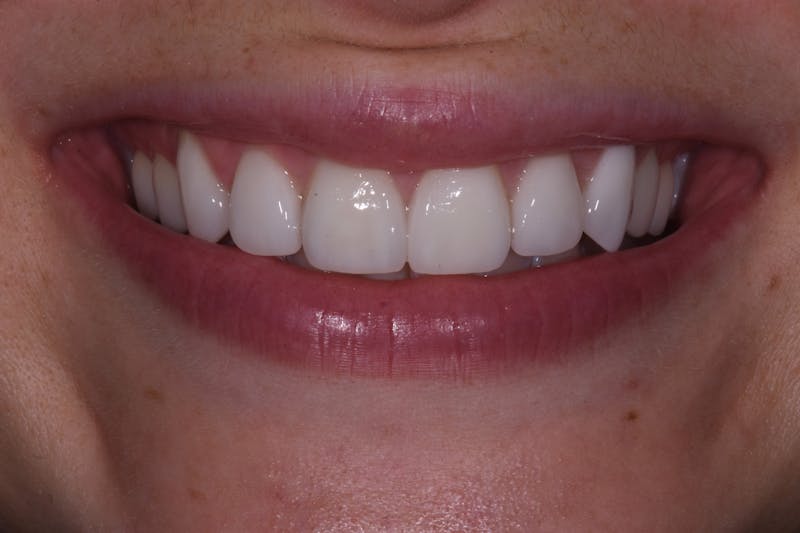 Patient Smile Before & After Gallery - Patient 352467 - Image 4
