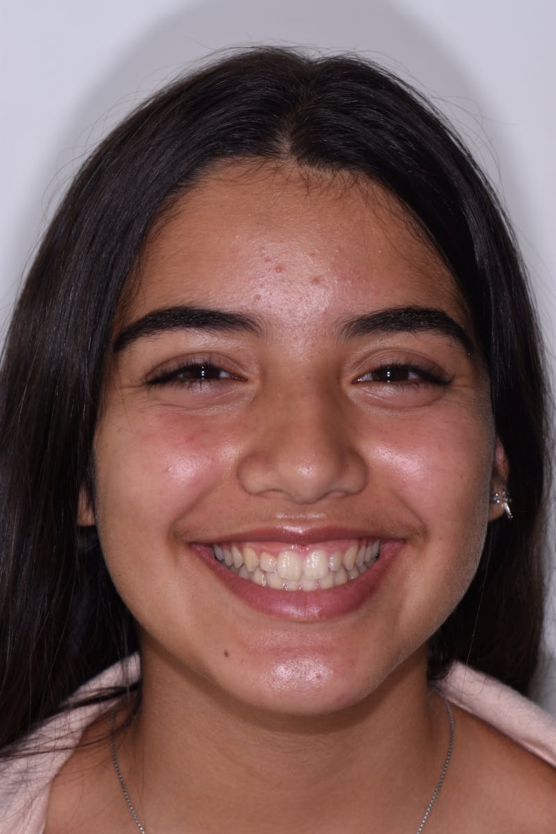 Patient Smile Before & After Gallery - Patient 295063 - Image 1