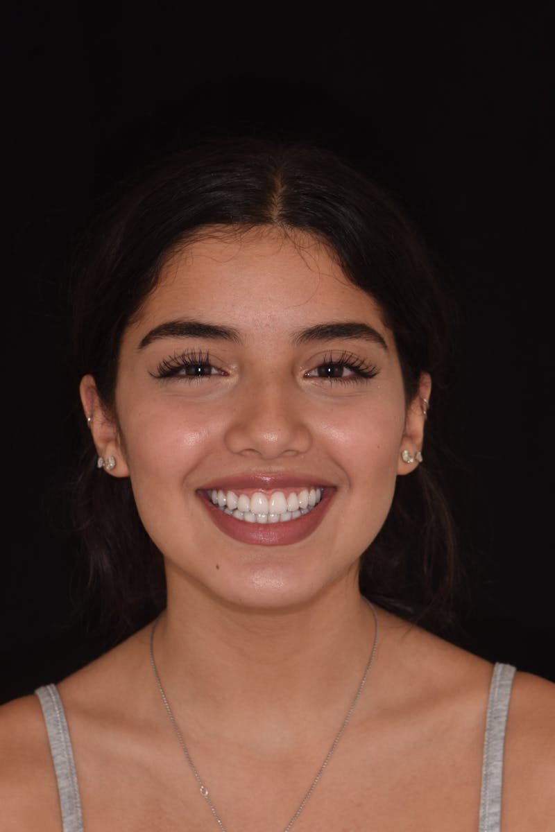 Patient Smile Before & After Gallery - Patient 295063 - Image 2