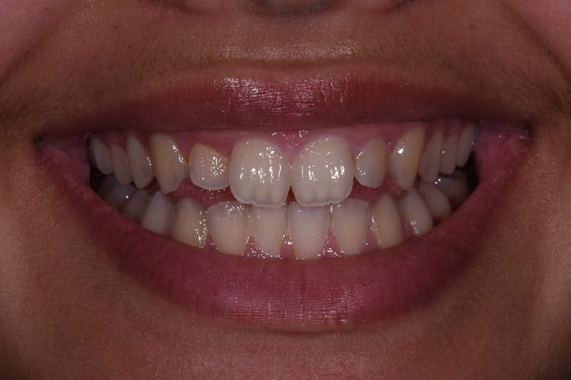 Patient Smile Before & After Gallery - Patient 295063 - Image 3