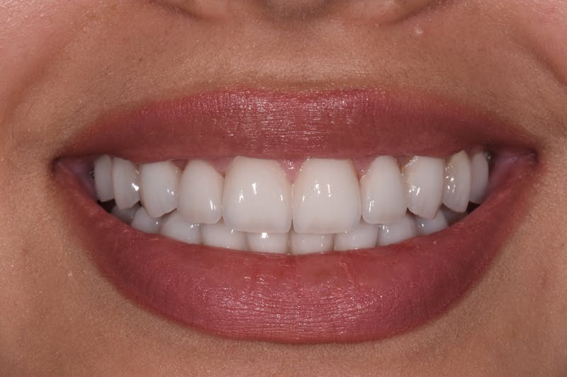 Patient Smile Before & After Gallery - Patient 295063 - Image 4