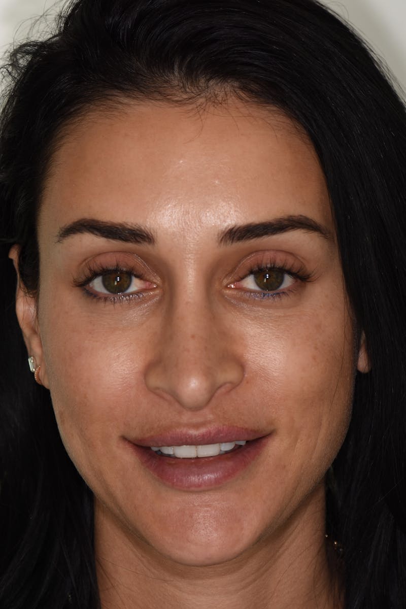 Patient Smile Before & After Gallery - Patient 190559 - Image 1