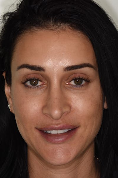 Patient Smile Before & After Gallery - Patient 190559 - Image 1