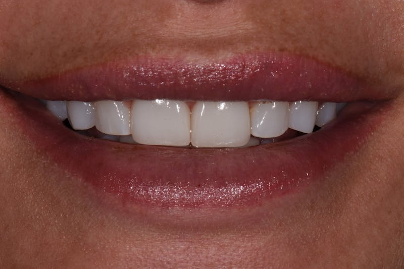 Patient Smile Before & After Gallery - Patient 190559 - Image 3