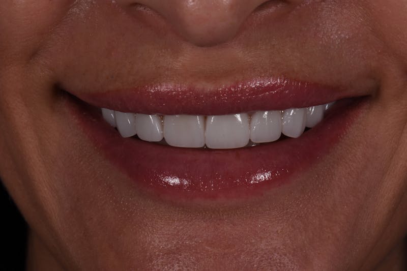 Patient Smile Before & After Gallery - Patient 190559 - Image 4